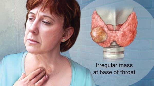 thyroid-cancer-metroentcare-ny