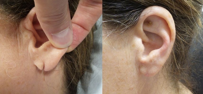 earlobe repair